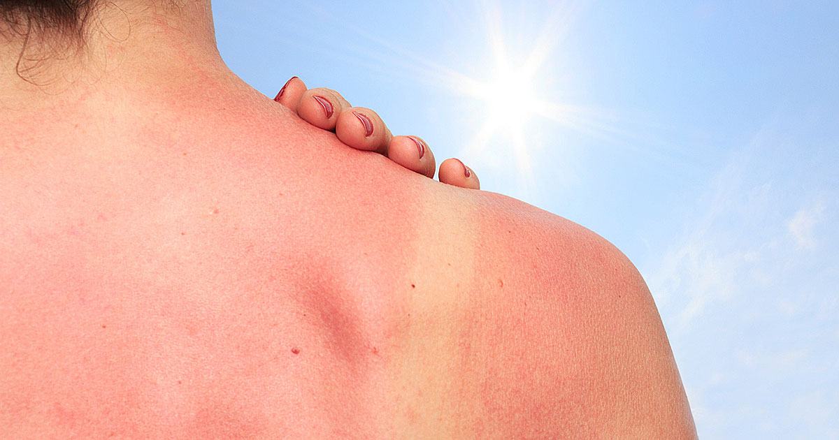 5 Dicas de como cuidar da pele queimada do sol